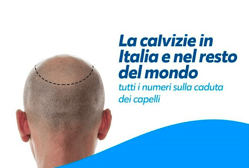 Calvizie, Le Vere Statistiche Sulla Caduta Dei Capelli